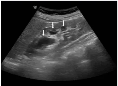 Figure 1: Ultrasound showing increased right kidney, with  pyelocaliceal dilation (arrows).