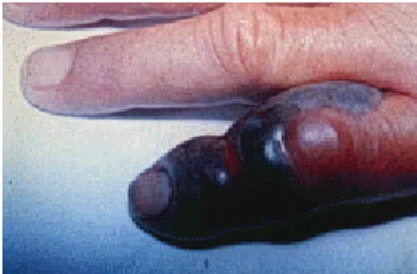 Figura 4: Caso de acidente botrópico, já no estágio de necrose.  