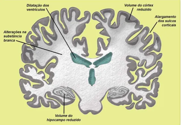 Figura 7: Imagem representativa de encéfalo humano em corte coronal, indicando possíveis  alterações morfológicas ocorridas em indivíduos com esquizofrenia, dentre as quais, dilatação dos 