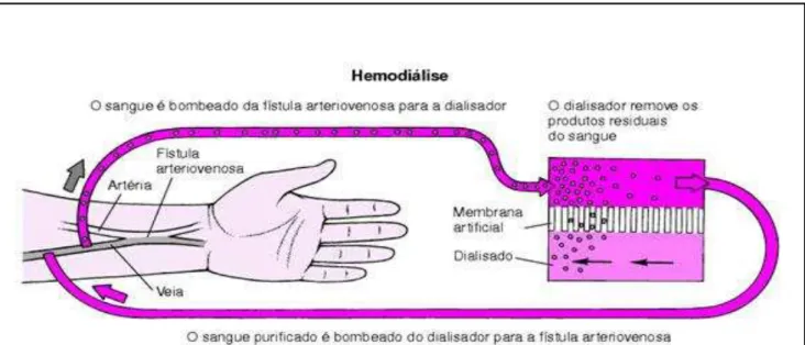 Figura 3- Hemodiálise. Fonte: Sociedade brasileira de nefrologia. 