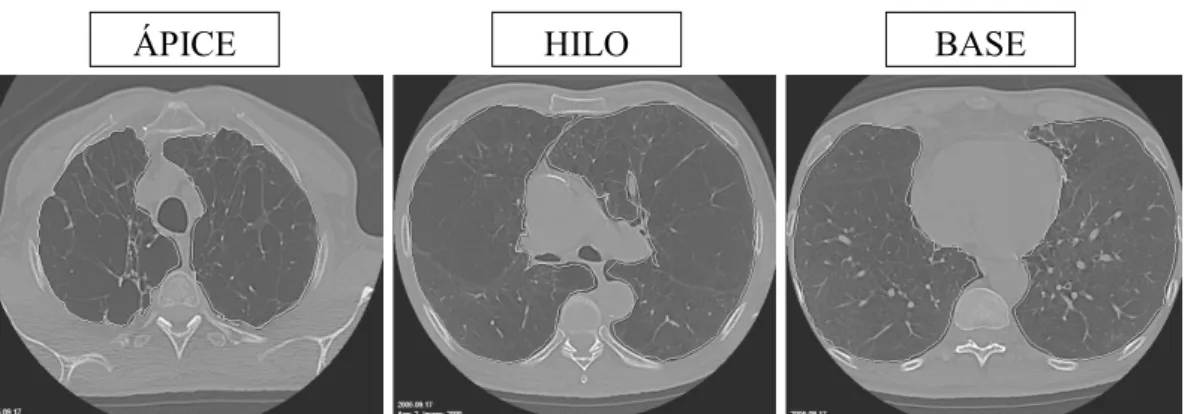 Figura 8 1 Cortes de um paciente com DPOC onde foram selecionadas as regiões de interesse (ROI) contornando os pulmões por meio de uma função do programa OSIRIS ® , regiões com densidades entre +100 e 11000UH