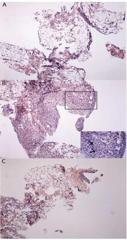 Figura  4-  Ilustração  representativa  da  histopatologia  sinovial  de  camundongos  submetidos  à  artrite  por  zymosan  e  tratados  com  o  extrato  de  Ascaris  suum.