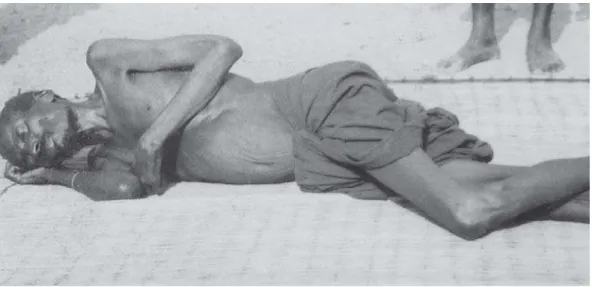 Figura 4: Doente portador de doença do sono, Ilha do Príncipe, 1901 (Imagem gentilmente cedida por Luis Marto)