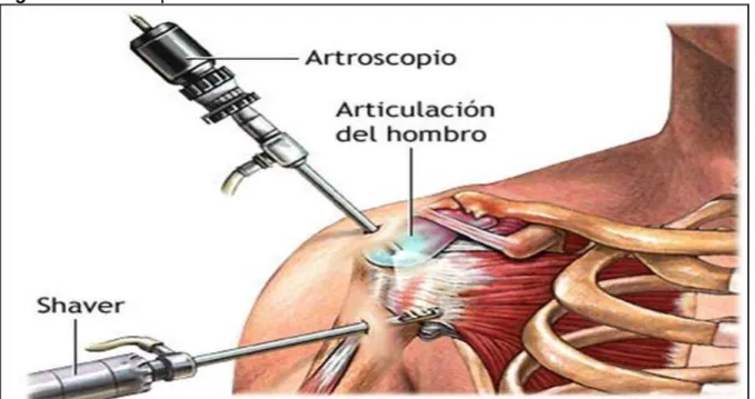 Figura 2: Artroscopia de ombro 