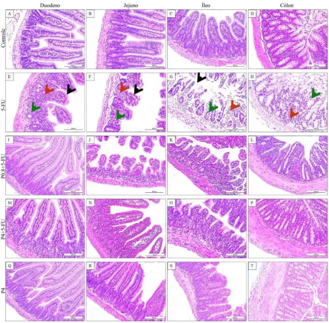 Figura 4 - Efeito do inibidor de S100  nas alterações histopatológicas do intestino delgado e  do cólon de camundongos submetidos à mucosite intestinal induzida por 5-FU