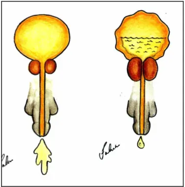 Figura 1: ilustração mostrando uma bexiga normal a direita e uma bexiga com paredes  espessadas,  com  volume  residual  aumentado  e  jato  diminuído,  secundário  a  obstrução  causada pela HPB a esquerda 