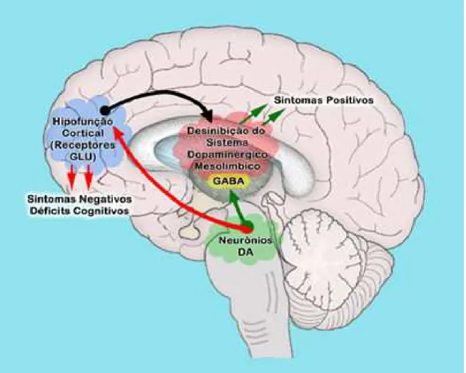 Figura 3: Representação hipotética associando a hipofunção cortical (redução da atividade de  receptores NMDA) e os sintomas da esquizofrenia