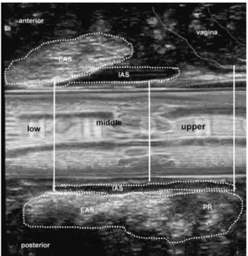 Fig. 1 Three-dimensional anorectal ultrasound image of anal sphinc- sphinc-ter intact