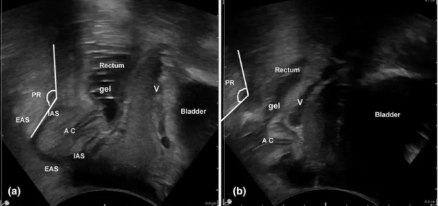 Fig. 6 Detection of rectocele (grade classified). a Echodefecogra- Echodefecogra-phy—Line 1 = measures the depth of the rectocele