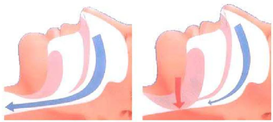 Figura 2 – Representação da obstrução respiratória na SAHSO 