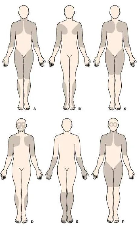 Figura 2 – Distribuição predominante da fraqueza muscular em diferentes tipos  de distrofias