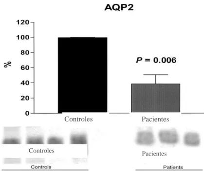 Figura 3.   Abundância da AQP2 na fração de exossomas urinários, pelo  Western  blotting,  normalizado  pela  creatinina  em  pacientes  com  LTA  e  deficit  de  concentração  urinária,  atendidos  na  Unidade  de  Atenção  Secundária  de       Barbalha-C