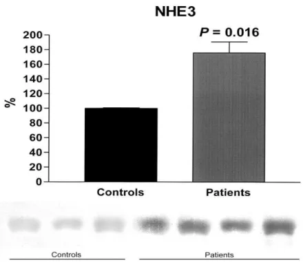 Figura 5.   Abundância do NHE3 na fração de exossomas urinários, pelo  Western  blotting, normalizado pela creatinina em pacientes com LTA e deficit de acidificação  urinária, atendidos na Unidade de Atenção Secundária de Barbalha-CE, entre julho  de  2008
