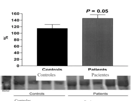 Figura 7.   Abundância  da  pendrina  na  fração  de  exossomas  urinários,  pelo  Western  blotting,  normalizado  pela  creatinina  em  pacientes  com  LTA,  e  deficit  de  acidificação urinária atendidos na Unidade de Atenção Secundária de Barbalha-CE,