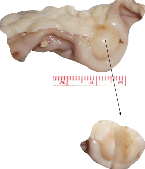 Figura 8 – Tumor de intestino delgado 