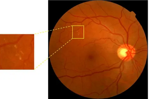 Figura 5 Ű Exemplo de imagem de retina com presença de microaneurismas.