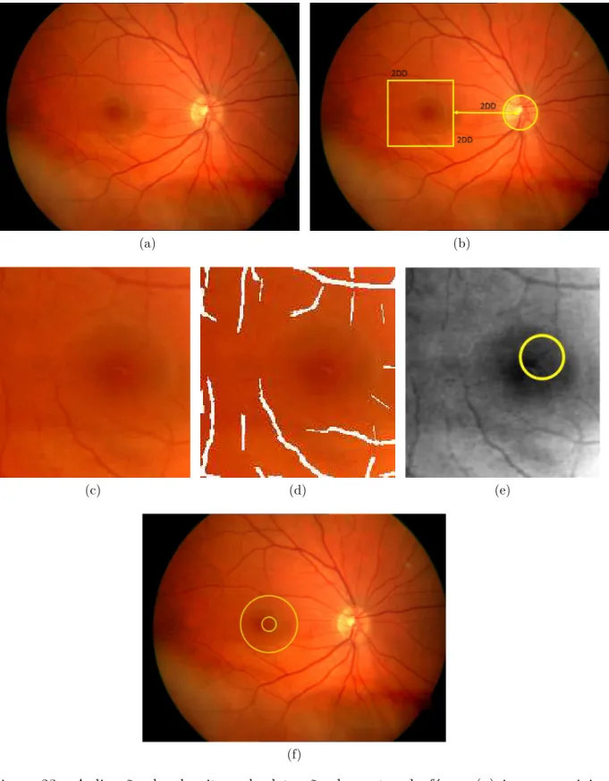 Figura 23 Ű Aplicação do algoritmo de detecção do centro da fóvea: (a) imagem origi- origi-nal, (b) determinação da ROI, (c) ROI em detalhe, (d) ROI com os vasos segmentados, (e) representação da ROI utilizando a fusão de bandas (o  cír-culo amarelo repres