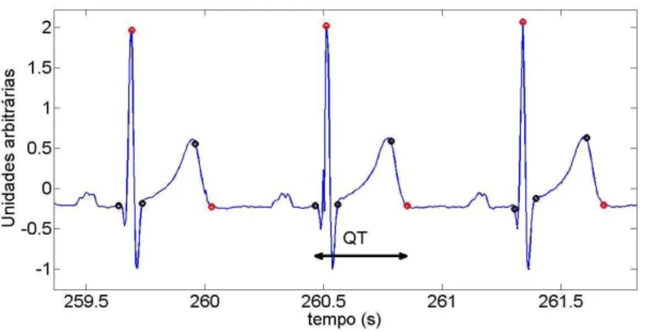 Figura 3.2: extra¸c˜ao de parˆ ametros a partir da segmenta¸c˜ao da onda T, sel16483 (Arrhythmia database).