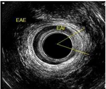 Figura 2. Avaliação do canal anal médio no escaneamento 1: lesão do esfíncter   anal interno (EAI) e integridade muscular do esfíncter anal externo (EAE).