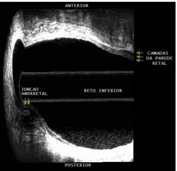 Figura 3. Escaneamento 2 com avaliação da junção anorretal e reto inferior   – paciente 5 do GI