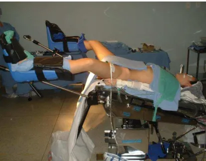 Figura  8.  Paciente  posicionada  na  mesa  cirúrgica  com  perneiras  em  abdução  e  posição                      Trendelemburg 