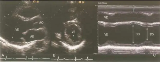 Figura 5-  Exemplos da  medição dos diâmetros sistólicos e  diastólicos  mediante  o corte  paraesternal, linha do cursor atravessando VE (A) e eixo curto ao bidimensional, à direita com  presença da linha do cursor no centro (B) e ao modo M (C), à esquerd