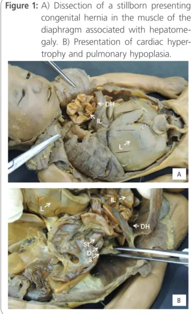 Figure 1:  A) Dissection of a stillborn presenting  congenital hernia in the muscle of the  diaphragm associated with  hepatome-galy