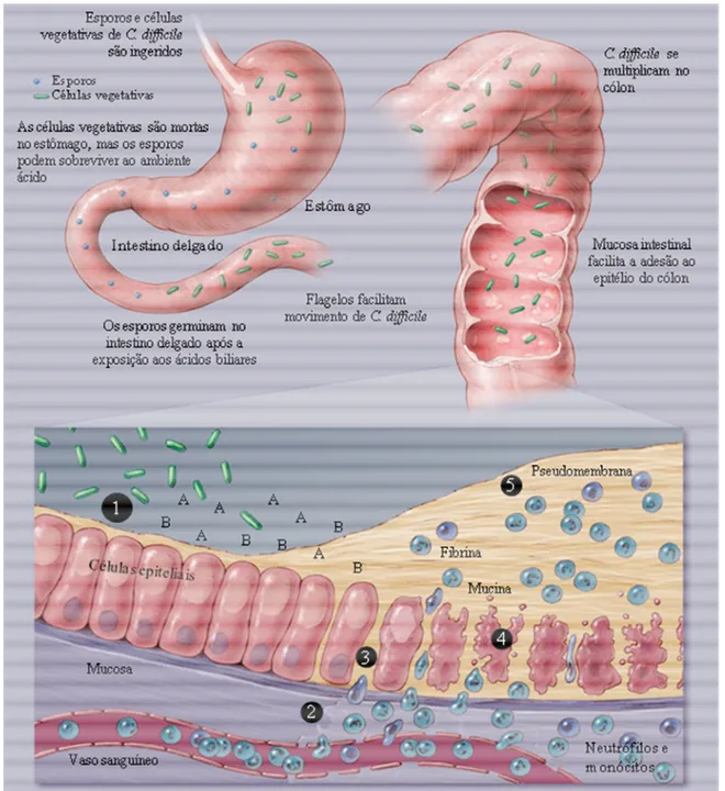 Figura 5: Patogênese da infecção por Clostridium difficile. 