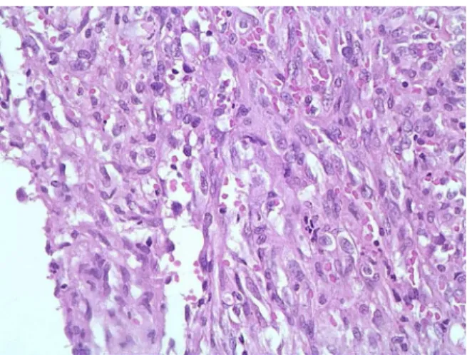 Fig. 8. Photomicrograph of the cardiac angiosarcoma exhibiting large pleomorphic spindle cells that appear to be vasoformative (HE, original magniﬁcation  400).