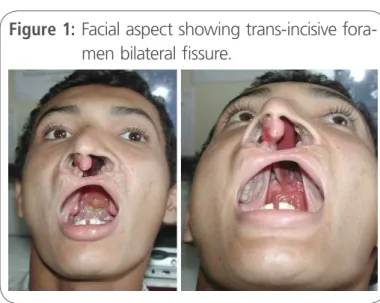 Figure 1:  Facial aspect showing trans-incisive fora- fora-men bilateral fissure.