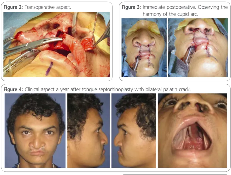 Figure 3:  Immediate postoperative. Observing the  harmony of the cupid arc.