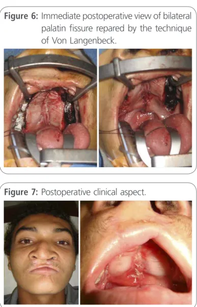 Figure 6:  Immediate postoperative view of bilateral  palatin fissure repared by the technique  of Von Langenbeck.