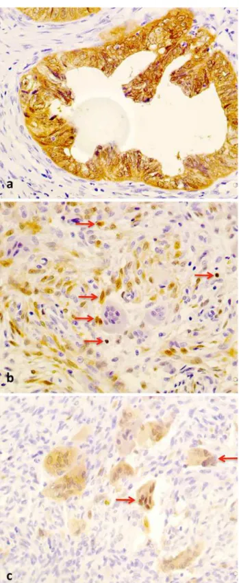 Fig. 3 Immunoreactivity for p16 INK4a , all in 9400. a Colon cancer, positive control