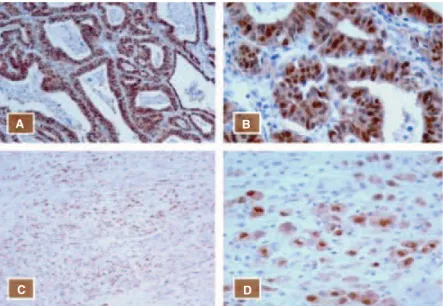 Fig. 1. Immunohistochemical staining for p16 INK4A protein (A, C: 100 · ; B, D: 400 · ) in formalin-ﬁxed paraﬃn- paraﬃn-embedded gastric adenocarcinomas