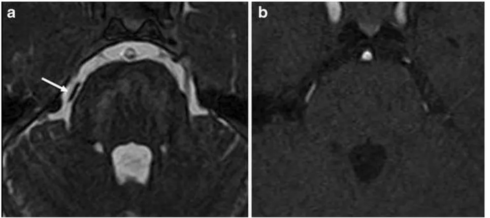 Figura 9 – Exame de RM correspondente ao paciente da Figura 8A, com compressão neurovascular (CNV) de Grau I