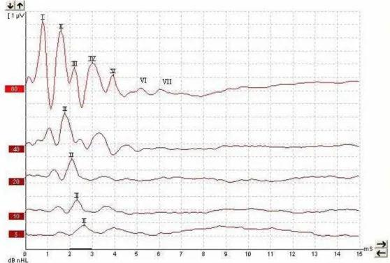 FIGURA 5 – Traçado normal de PAETE de rato mostrando as 7 ondas em 80 dB NA (traçado superior) e o  aumento progressivo da latência, diminuição da amplitude e desaparecimento progressivo das ondas com a  diminuição da intensidade de estímulo, permanecendo 