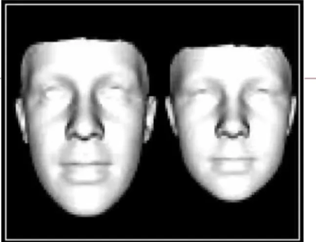 Figura 2. Rasgos faciales: fenotipo SXF (izquierda) y normal (derecha)