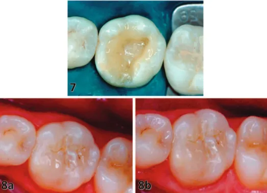 Figure 9. Extensive amalgam resto- resto-ration without marginal adaptation in the maxillary right first molar (#3).