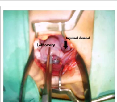 Figure 1: Vulvo-vaginal image of physical exam conirming vaginal agenesis.