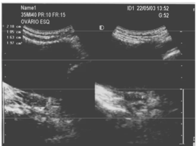 FIGURA 3 – Imagem ultra-sonográfica das medidas do ovário esquerdo 