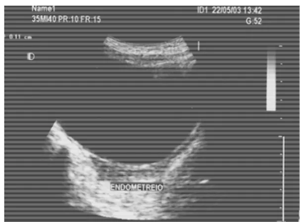 FIGURA 5 – Imagem ultra-sonográfica da espessura do eco endometrial 