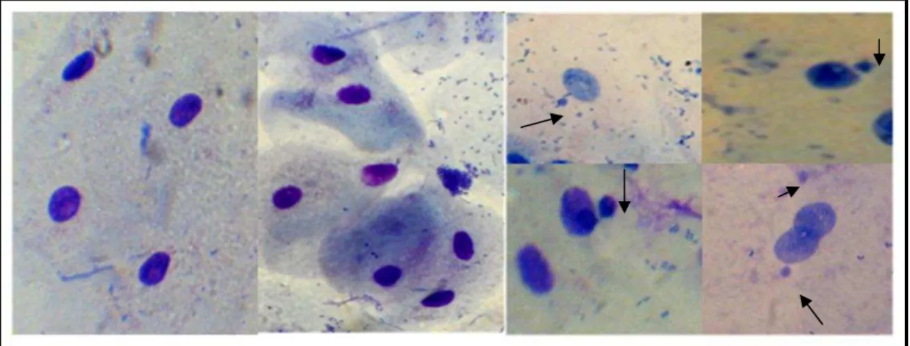 Figura 03. Fotomicrografias de células de epitélio esfoliado de mucosa bucal sem anormalidade, e  com micronúcleos, indicativos de mutagenicidade.
