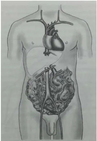 Figura 1 - Método Piggyback de transplante de fígado. 