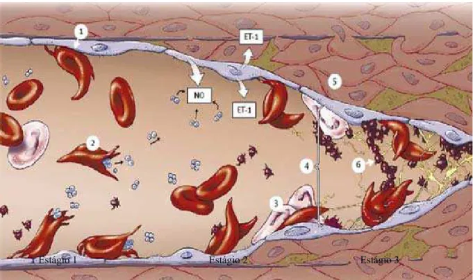 Figura 4 - Vasculopatia e AVC na anemia falciforme. (1) He adere ao vaso. (2) Hemólise