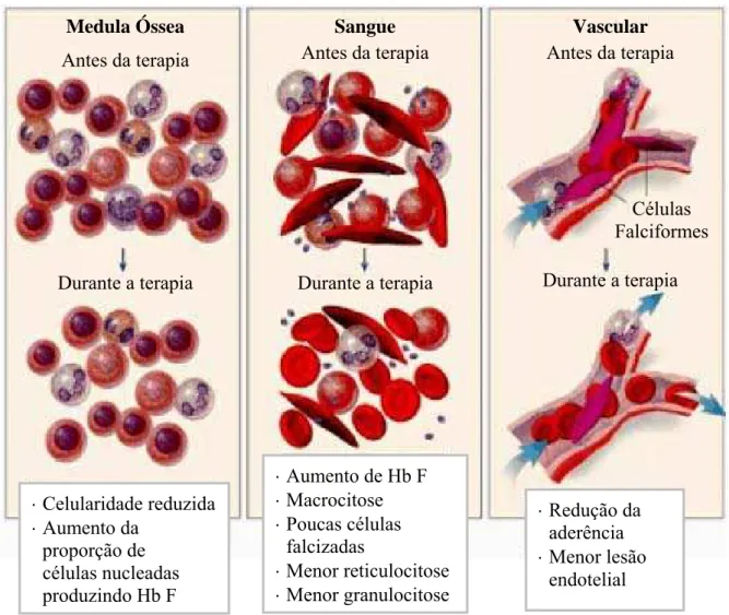 Figura 7- Mecanismo de ação da hidroxiuréia na anemia falciforme a nível sanguíneo,  vascular e na medula óssea