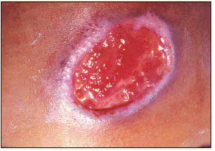 Figura  4:  LTA  –   Úlcera  apresentando  bordas  elevadas com fundo granuloso vermelho