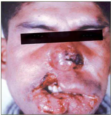 Figura 5 - LTA forma mucosa grave com acometimento de mucosa  nasal, palato e lábios e desfiguração da face