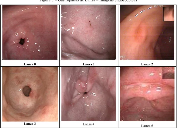 Figura 3 – Gastropatias de Lanza – Imagens endoscópicas 