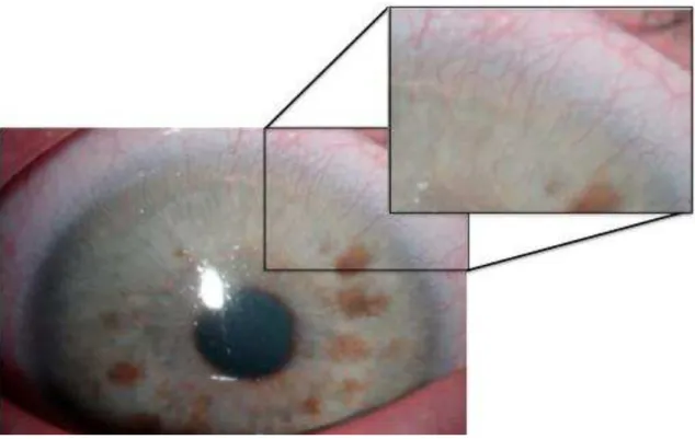 Figura 2. Neovascularização corneana secundário ao uso inadequado e prolongado de lentes  de contato, com ênfase em alguns neovasos superficiais superiores.