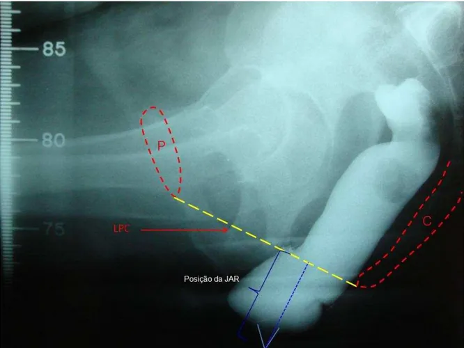 Figura 3 – Paciente 26 – filme estático de PED em repouso, com as marcações das estruturas ósseas  utilizadas como referência para análise da posição da junção ano-retal (JAR)